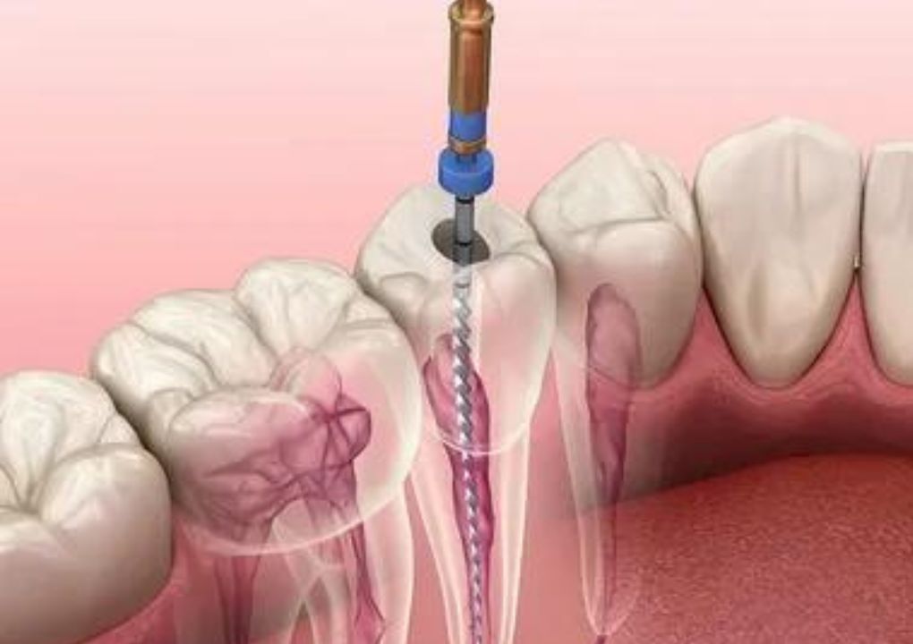 Best Root Canal Treatment In Hayward